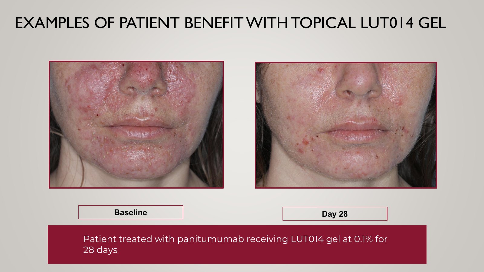 Slide 14, EXAMPLES OF PATIENT BENEFIT WITH TOPICAL LUT014 GEL