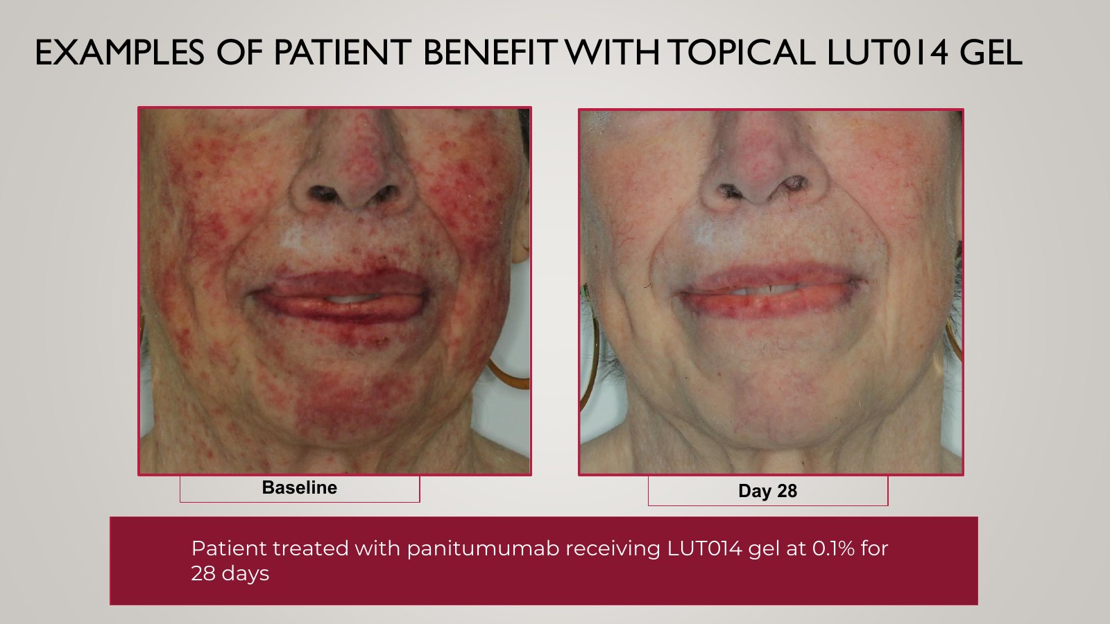 Slide 13, EXAMPLES OF PATIENT BENEFIT WITH TOPICAL LUT014 GEL